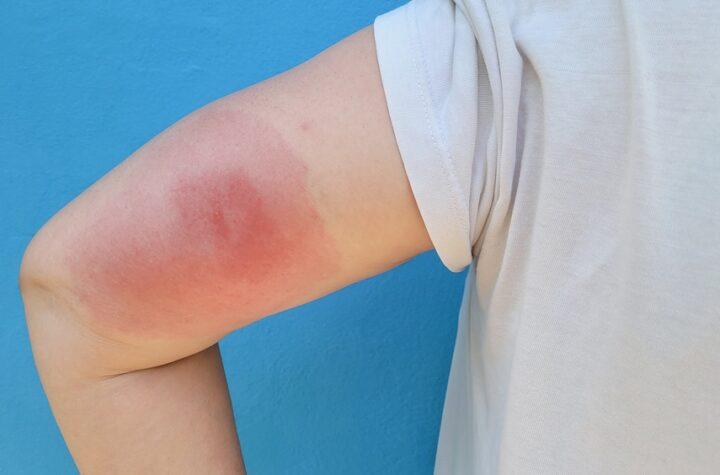 Understanding Skeeter Syndrome: When Mosquito Bites Cause More Than Just Itching